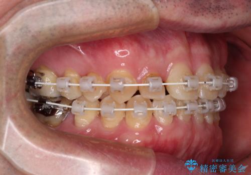 受け口を治す　ワイヤー装置での矯正治療の治療中