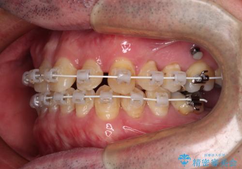 受け口を治す ワイヤー装置での矯正治療の治療中