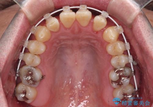 受け口を治す ワイヤー装置での矯正治療の治療中