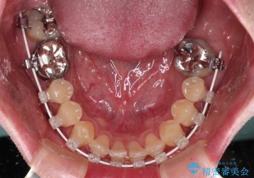 受け口を治す ワイヤー装置での矯正治療の治療中
