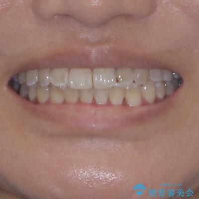 全く目立たないワイヤー矯正 上下裏側矯正の治療後(顔貌)