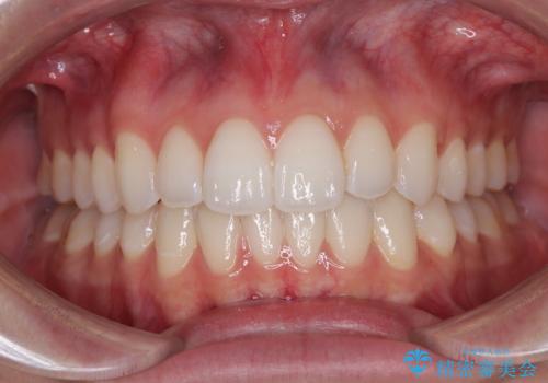 【モニター】前に傾斜した前歯 インビザラインでスッキリとした口元にの症例 治療後