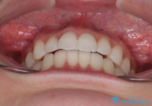 【モニター】前に傾斜した前歯 インビザラインでスッキリとした口元にの治療後