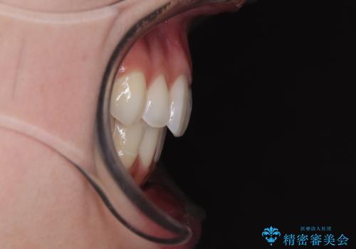 【モニター】前に傾斜した前歯 インビザラインでスッキリとした口元にの治療後
