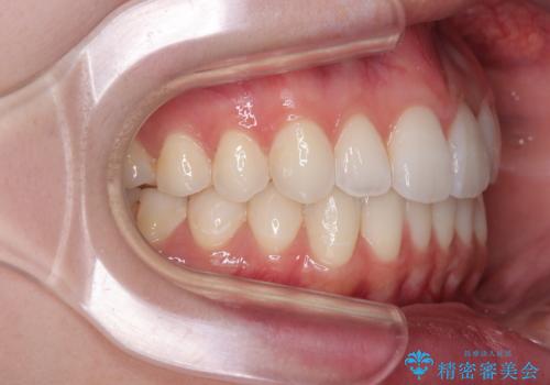 【モニター】前に傾斜した前歯 インビザラインでスッキリとした口元にの治療後