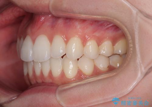 【モニター】前に傾斜した前歯 インビザラインでスッキリとした口元にの治療後