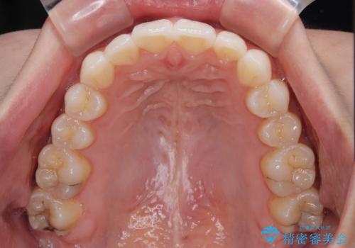 【モニター】前に傾斜した前歯 インビザラインでスッキリとした口元にの治療後