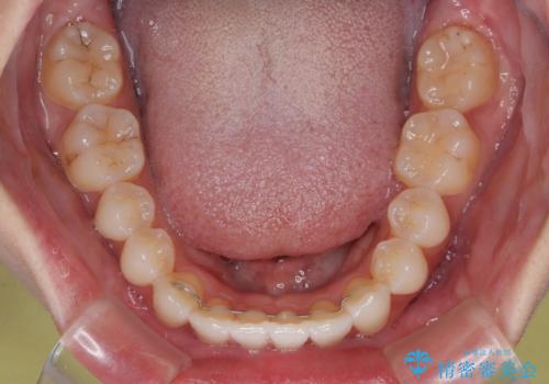 【モニター】前に傾斜した前歯 インビザラインでスッキリとした口元にの治療後