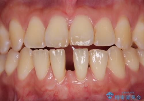 半分以上歯根が見えている　歯肉移植による根面被覆術の治療後