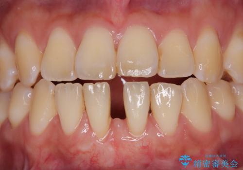 半分以上歯根が見えている 歯肉移植による根面被覆術の治療後