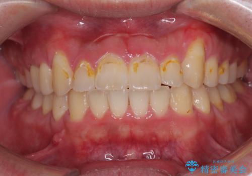 目立つ八重歯を非抜歯矯正で整える 目立たないワイヤー矯正の症例 治療後