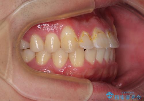 目立つ八重歯を非抜歯矯正で整える 目立たないワイヤー矯正の治療後