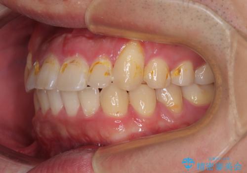 目立つ八重歯を非抜歯矯正で整える 目立たないワイヤー矯正の治療後