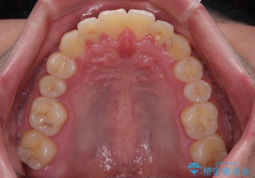 目立つ八重歯を非抜歯矯正で整える 目立たないワイヤー矯正の治療後