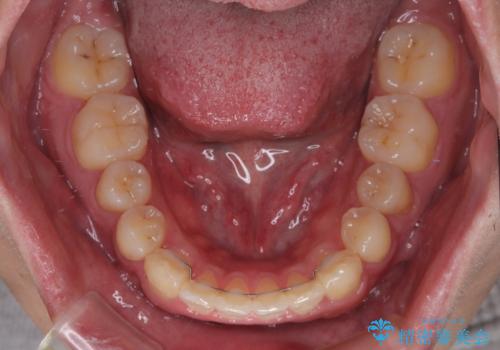 目立つ八重歯を非抜歯矯正で整える 目立たないワイヤー矯正の治療後