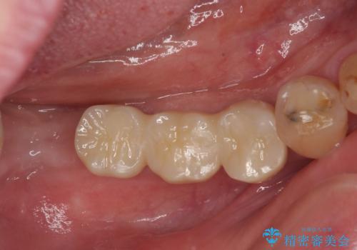 入れ歯が全く使えない　奥歯のインプラント治療の治療後