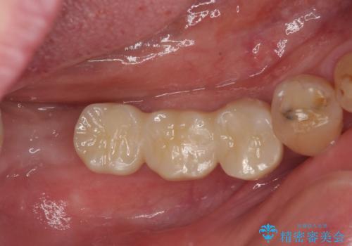 入れ歯が全く使えない 奥歯のインプラント治療の症例 治療後