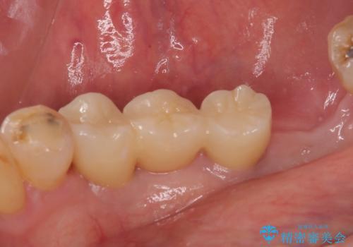 入れ歯が全く使えない 奥歯のインプラント治療の治療後