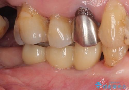 入れ歯が全く使えない 奥歯のインプラント治療の治療後