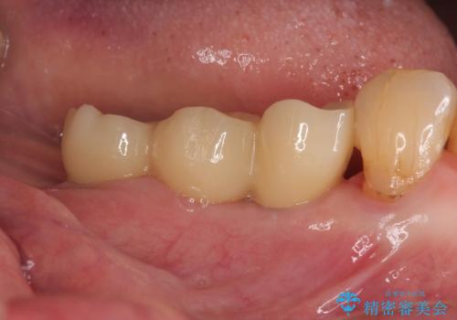 入れ歯が全く使えない　奥歯のインプラント治療の治療後