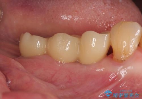 入れ歯が全く使えない 奥歯のインプラント治療の治療後