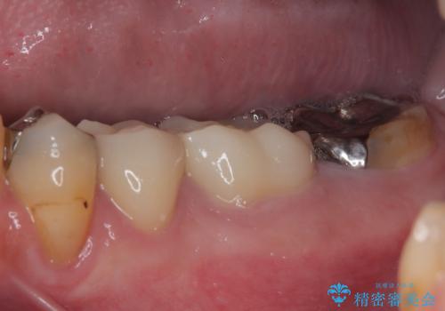 何度通院しても痛みが引かない 転医による根管治療の治療後