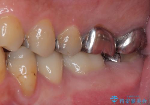 何度通院しても痛みが引かない 転医による根管治療の治療後