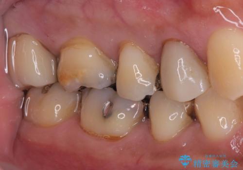 【フルジルコニアクラウン】銀歯二次カリエス!の治療後