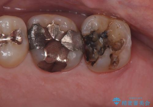 【フルジルコニアクラウン】銀歯二次カリエス!の治療前