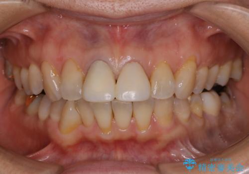 【非抜歯】加速矯正で超短期間治療!噛み合わせが劇的に改善の症例 治療前