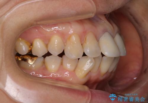 【非抜歯】加速矯正で超短期間治療!噛み合わせが劇的に改善の治療前