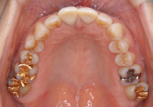 【非抜歯】加速矯正で超短期間治療!噛み合わせが劇的に改善の治療前