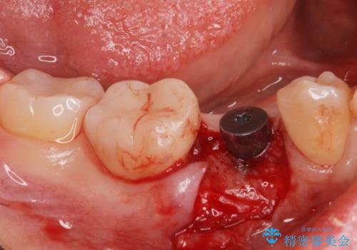 インプラント治療の治療中