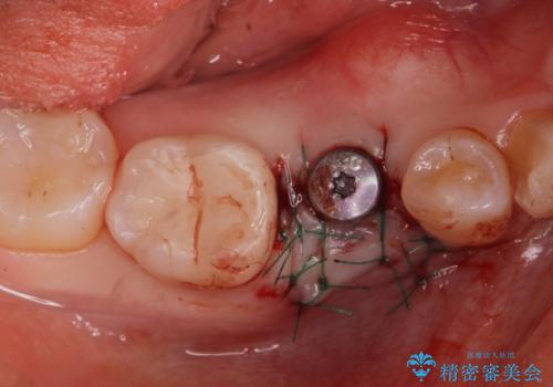 インプラント治療の治療後