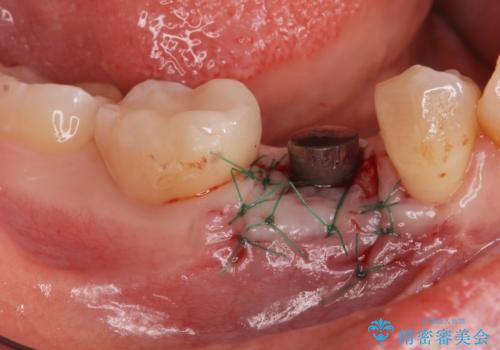 インプラント治療の治療後