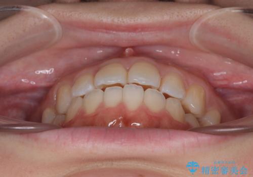 再矯正 開咬に後戻りした歯列をインビザラインで改善の治療後