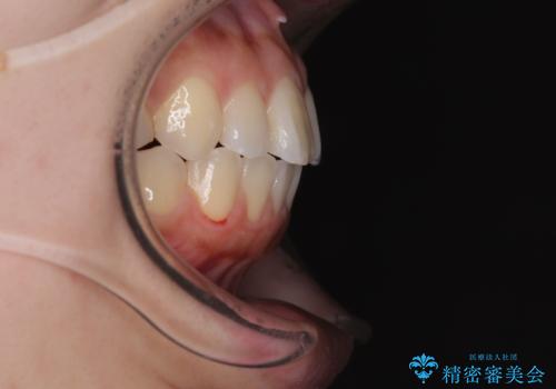 再矯正 開咬に後戻りした歯列をインビザラインで改善の治療後