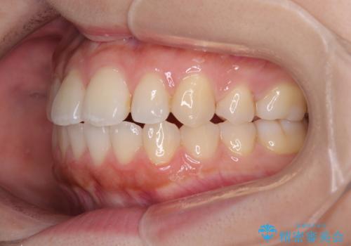 再矯正 開咬に後戻りした歯列をインビザラインで改善の治療後