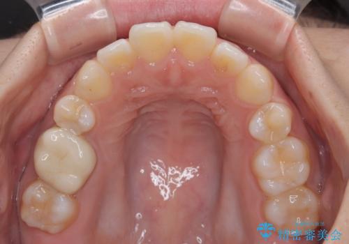 再矯正 開咬に後戻りした歯列をインビザラインで改善の治療後