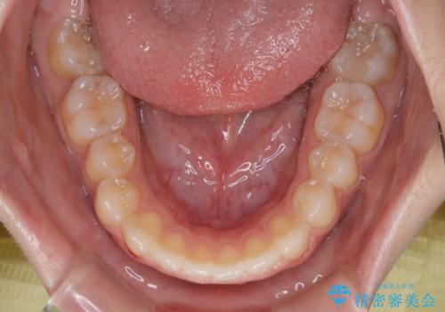 再矯正 開咬に後戻りした歯列をインビザラインで改善の治療後
