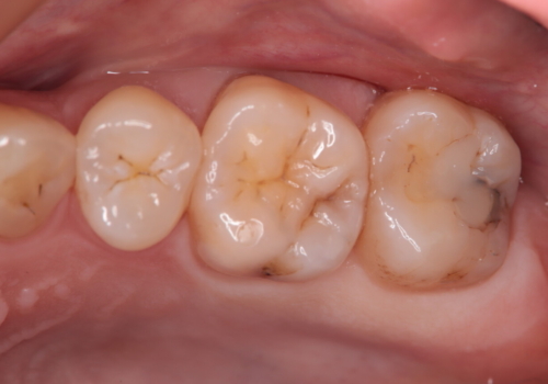 虫歯の再発　セラミックインレーにて治療の治療前