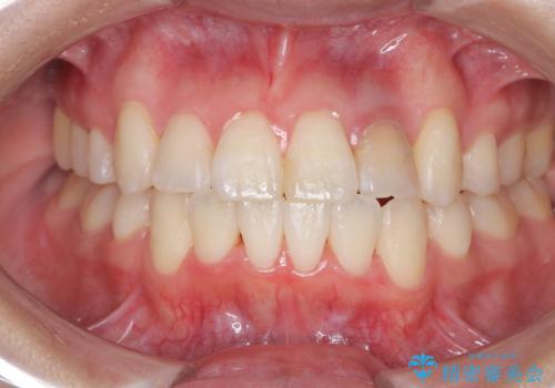 【ワイヤー矯正】八重歯 歯のでこぼこを治したい!の症例 治療後