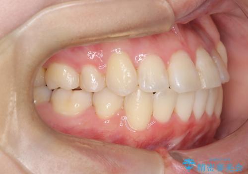 【ワイヤー矯正】八重歯 歯のでこぼこを治したい!の治療後