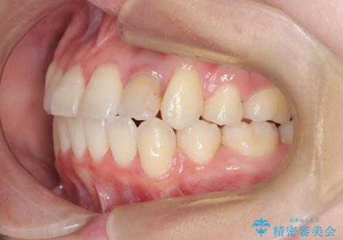 【ワイヤー矯正】八重歯 歯のでこぼこを治したい!の治療後