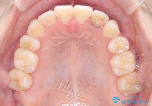 【ワイヤー矯正】八重歯 歯のでこぼこを治したい!の治療後