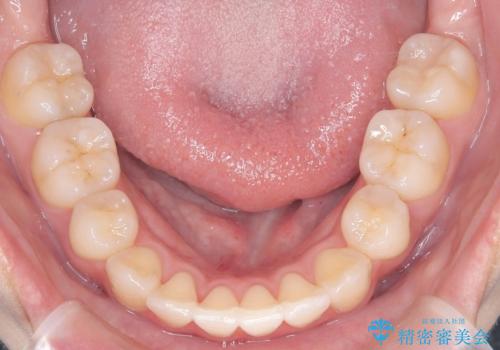 【ワイヤー矯正】八重歯 歯のでこぼこを治したい!の治療後