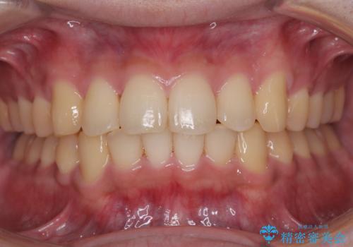 前歯のデコボコを治したい ワイヤー装置での非抜歯矯正の症例 治療後