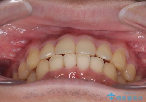 前歯のデコボコを治したい ワイヤー装置での非抜歯矯正の治療後