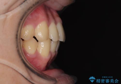 前歯のデコボコを治したい ワイヤー装置での非抜歯矯正の治療後