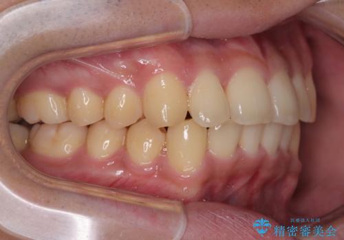 前歯のデコボコを治したい ワイヤー装置での非抜歯矯正の治療後